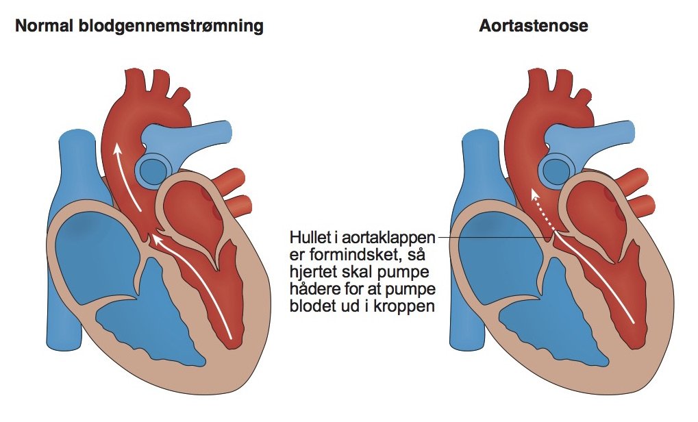 24-aortastenose-blodretning-figur-kopi