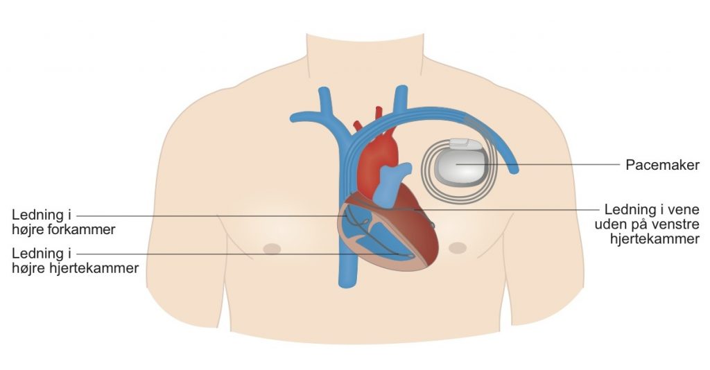 Biventrikul pacemaker figur